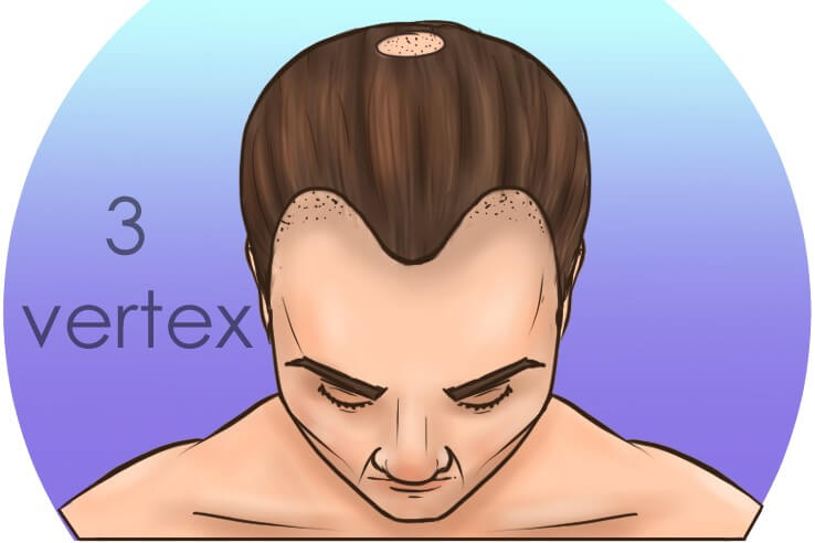 Norwood 3 Hair Loss Everything You Need To Know  Get In Touch