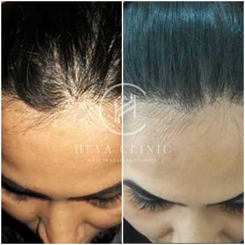 female 1000 hair transplant before after