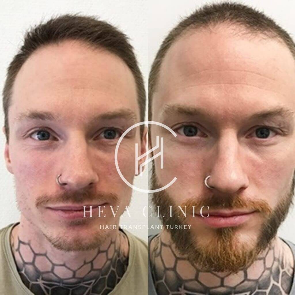 2000 hair transplant before after