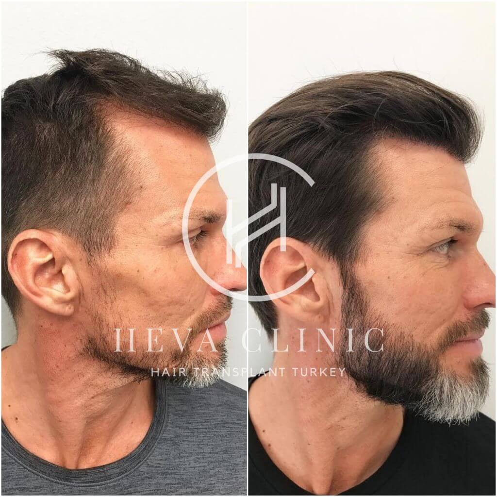 2500 grafts hair transplant