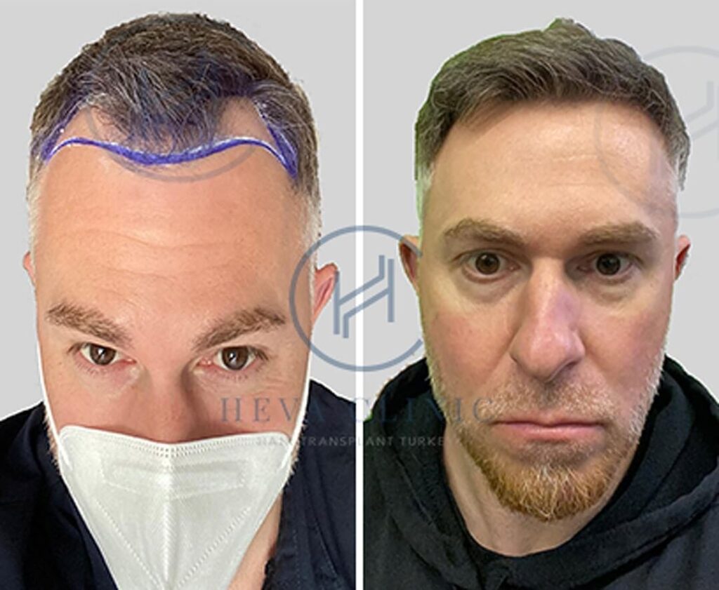 2500 hair transplant before after