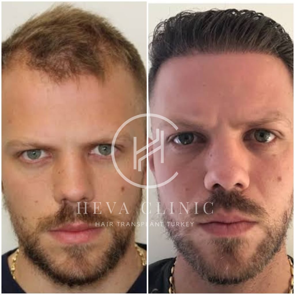 3213 hair graft transplant before after
