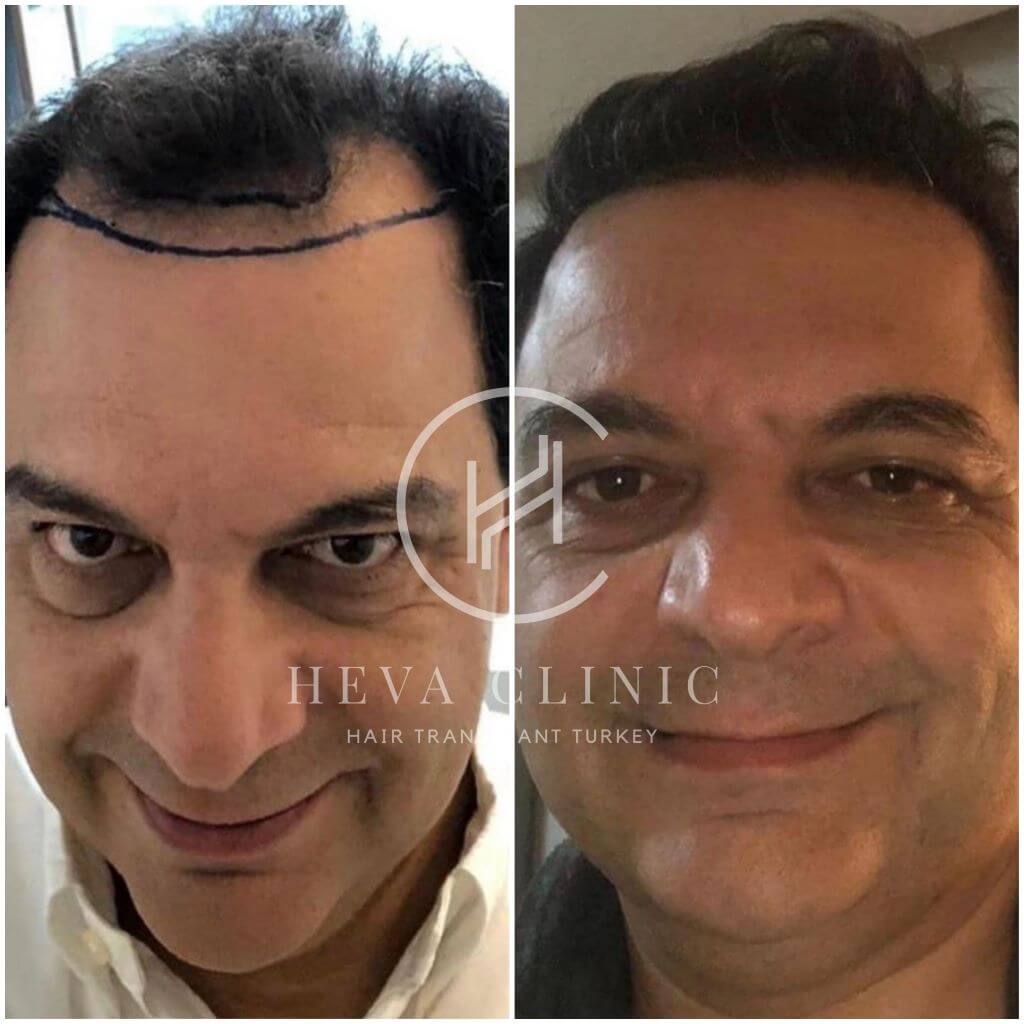 3500 grafts implantation patient before after
