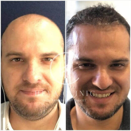 5000+ graft hair transplant heva clinic before after