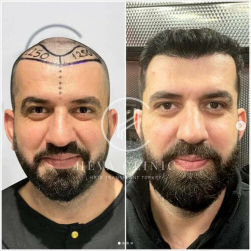 before after male dhi hair transplant patient