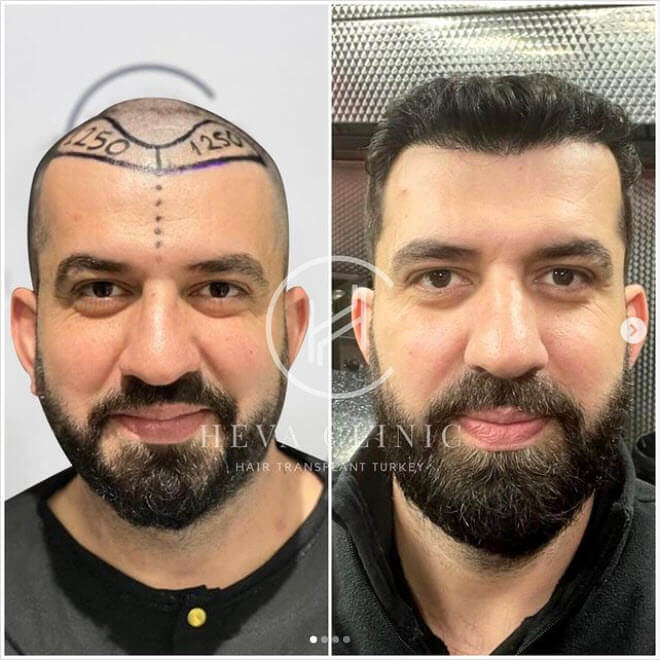before after male hair transplant patient