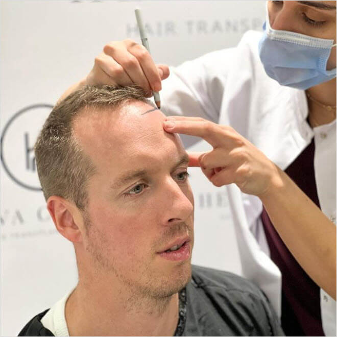 3000 Grafts Hair Transplant - Operation and Cost - Heva Clinic