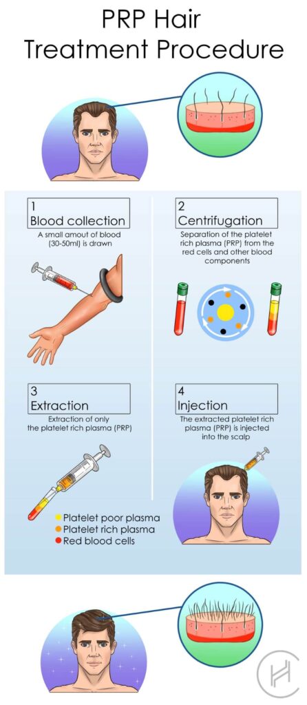 prp hair loss treatment procedure steps