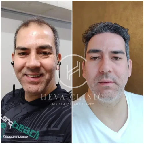 fue hair transplant 5000 grafts