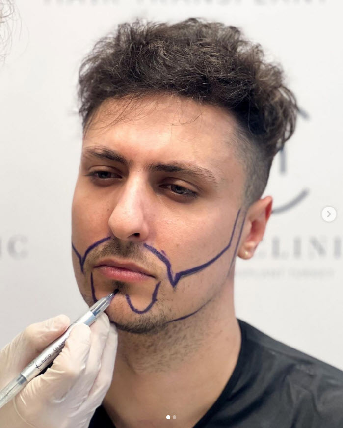 beard transplant patient pre operation at heva clinic istanbul turkey