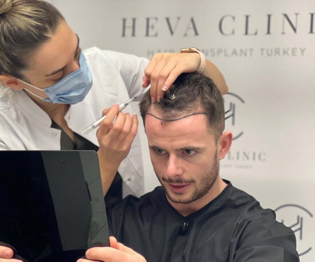 drawing hairline heva clinic suitable hair transplant patient