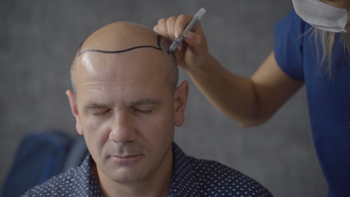 hair graft turkey