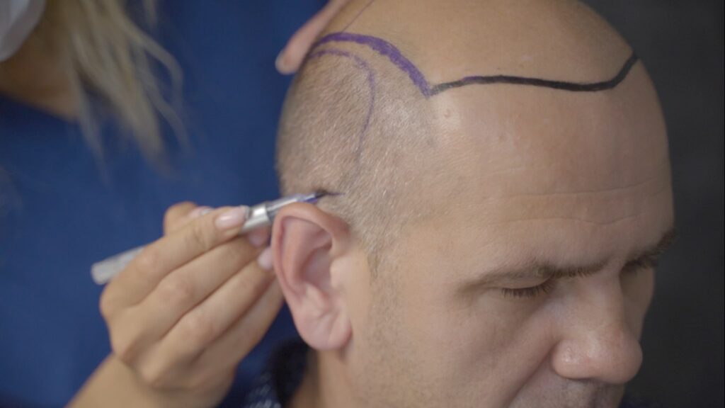 7000 Grafts Hair Transplant Turkey - Operation and Cost - Heva Clinic 7000 Grafts Hair Transplant Turkey - Operation and Cost - Heva Clinic