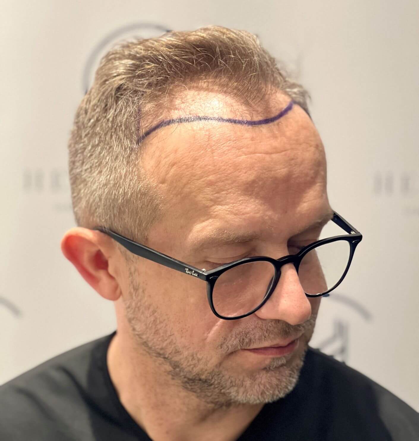 The Buzz on Buzz Cuts The Latest Hair Transplant Trend