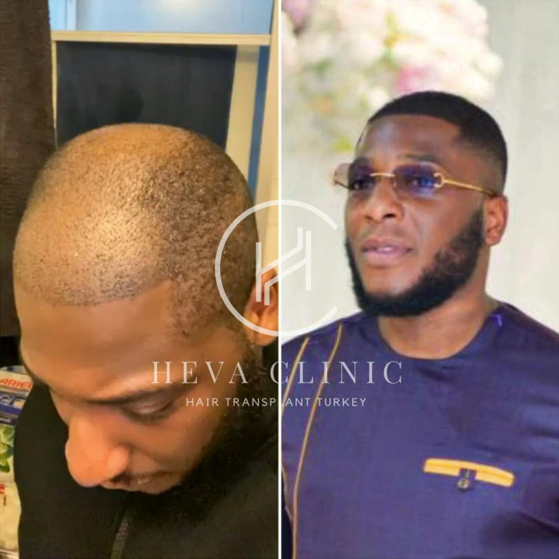 4782 grafts black male hair transplant before after