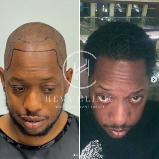 3200 grafts black male hair transplant turkey before after