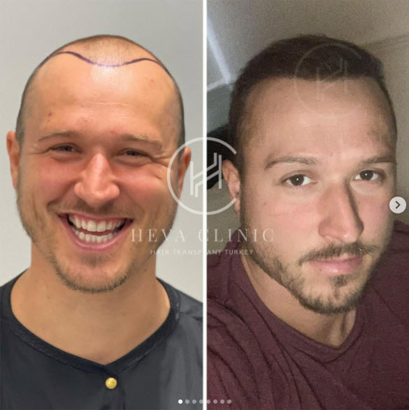 3982 grafts hair transplant before after turkey heva clinic