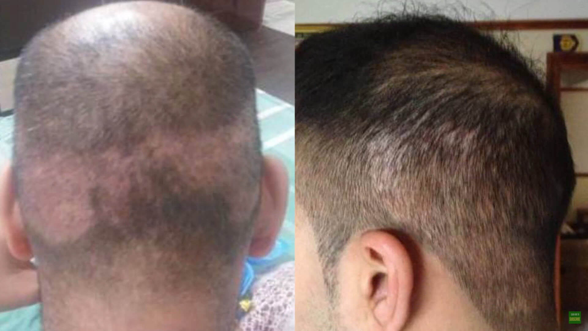 Why is FUE Hair Transplant the Best Solution?