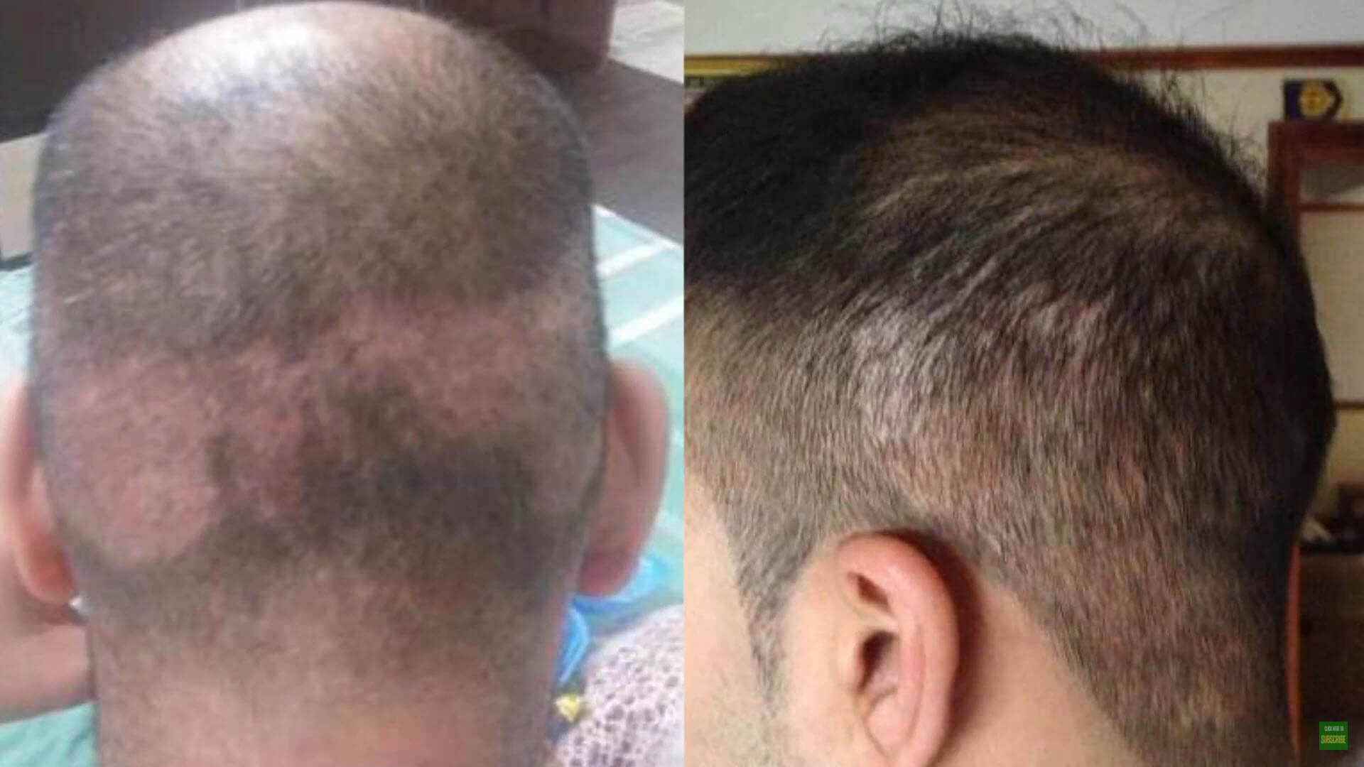 Causes of Unsuccessful Hair Transplantation  HairAvrasya  International Hair  Transplantation Center