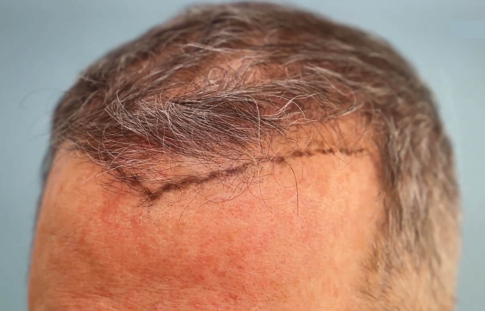 second hair transplant candidate side