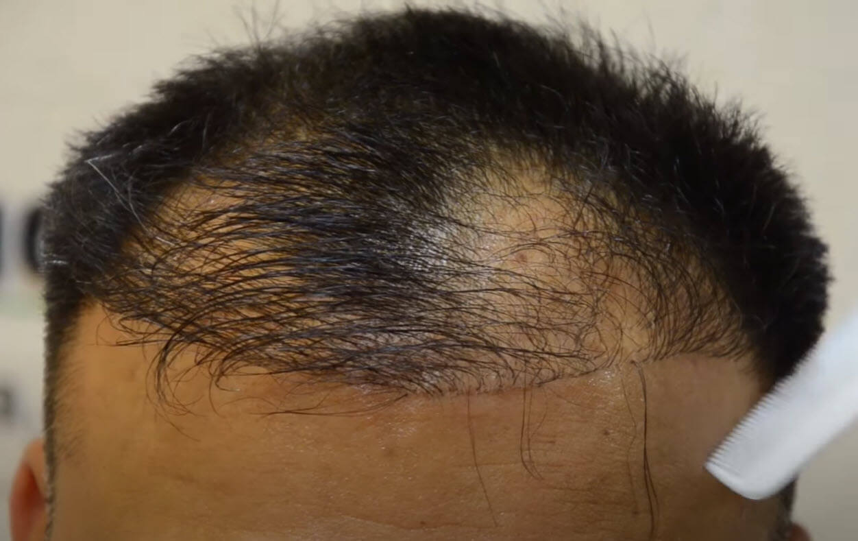 wrong hair transplant frontline