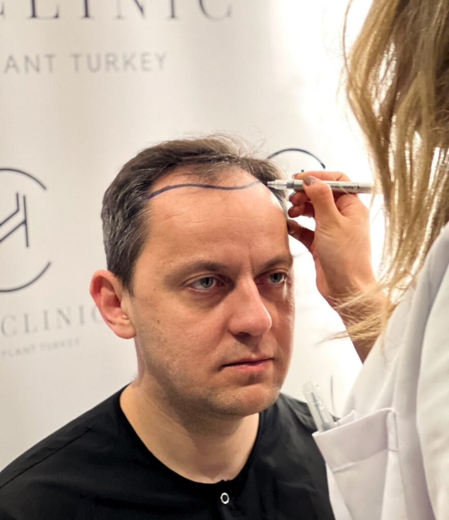 4000 grafts hair transplant heva clinic turkey drawing hairline