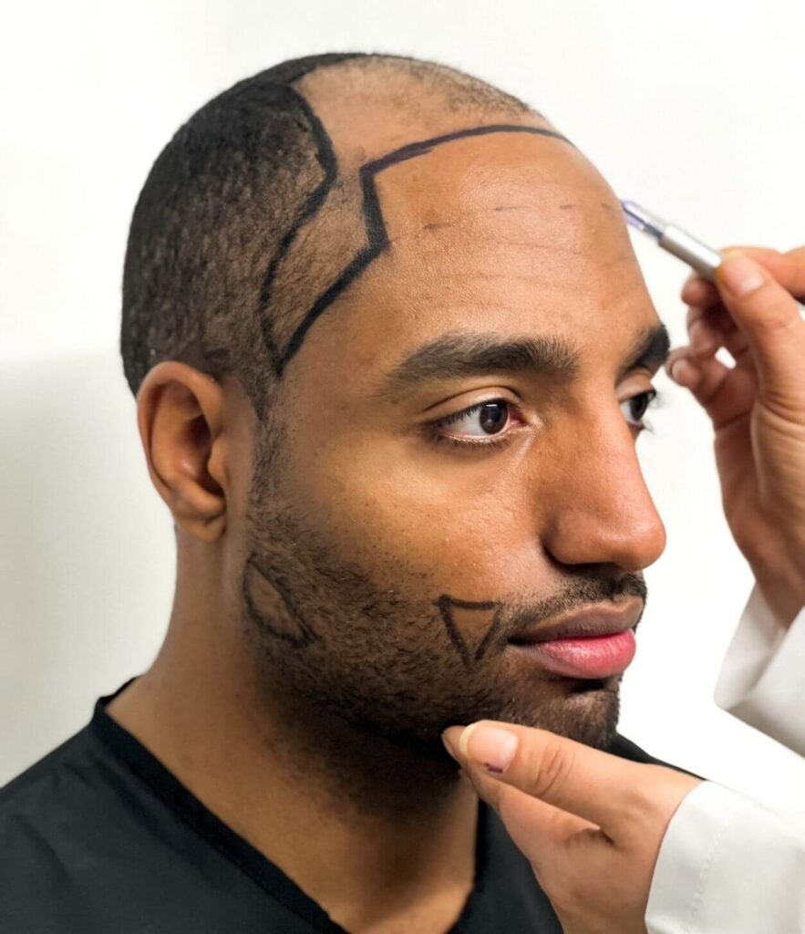 afro black man beard and hair transplant