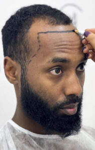 afro hair transplant at heva clinic