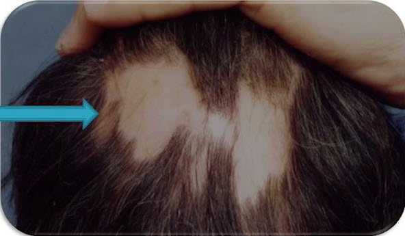 alopecia scarring