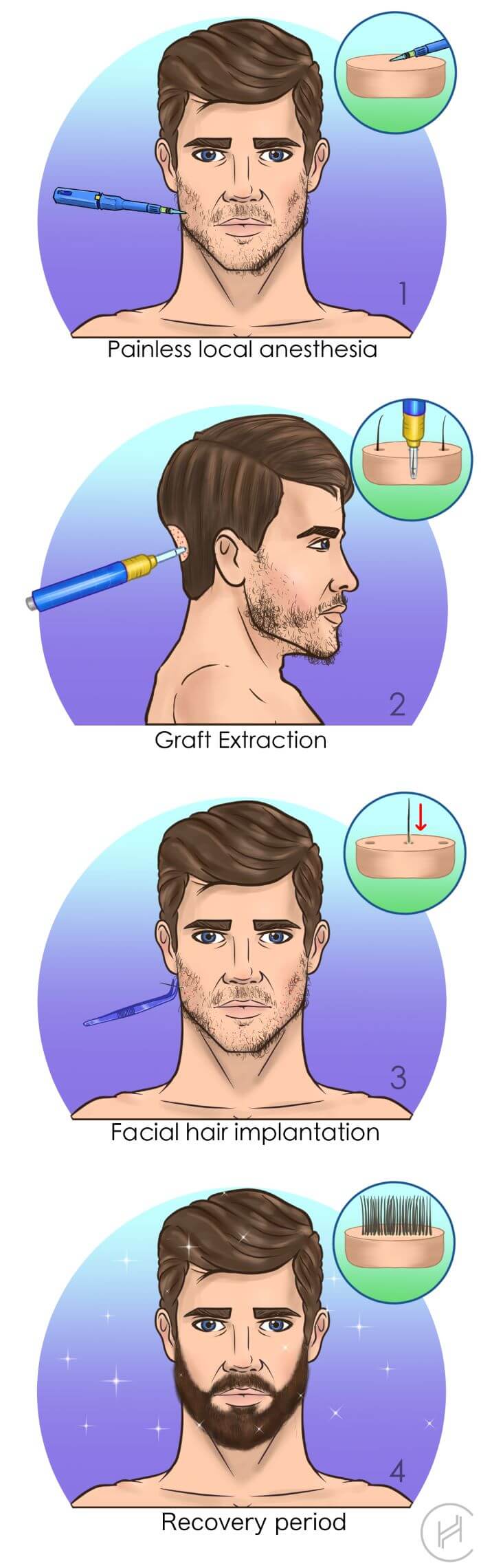 beard transplant process steps