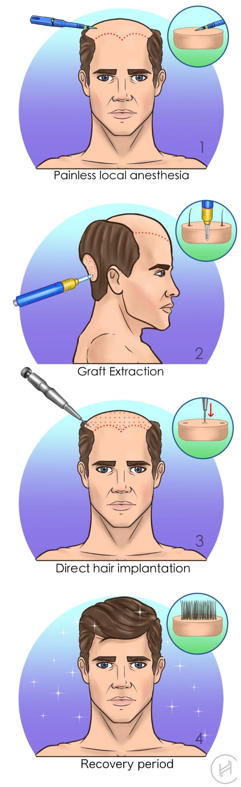 dhi choi pen hair transplant process steps