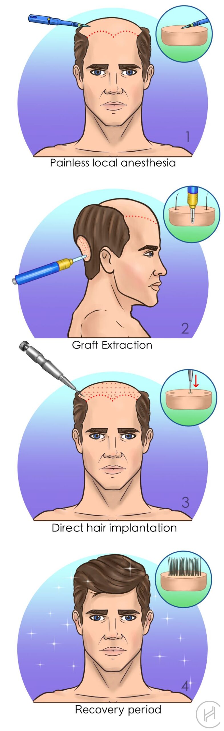 dhi choi pen hair transplant process dhi choi pen hair transplant process steps