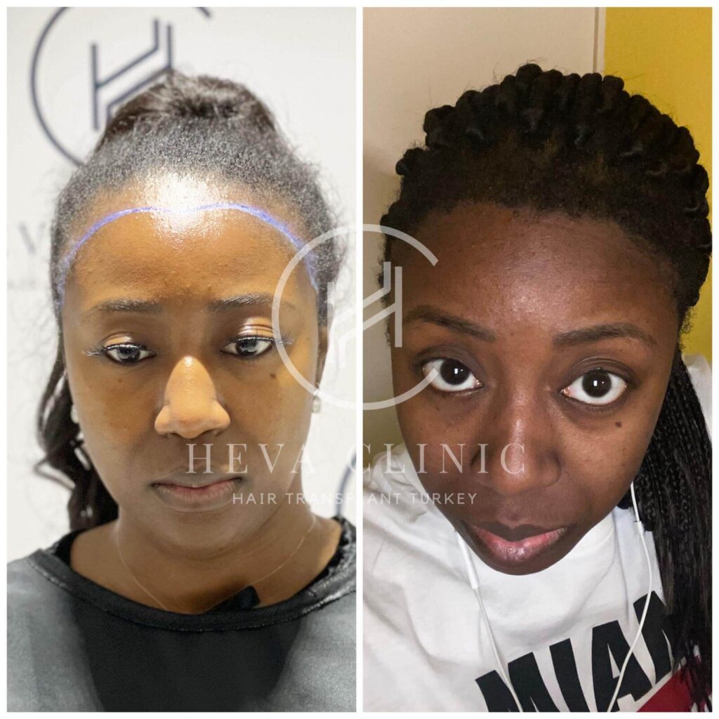 female black afro before after turkey heva clinic 2930 Grafts