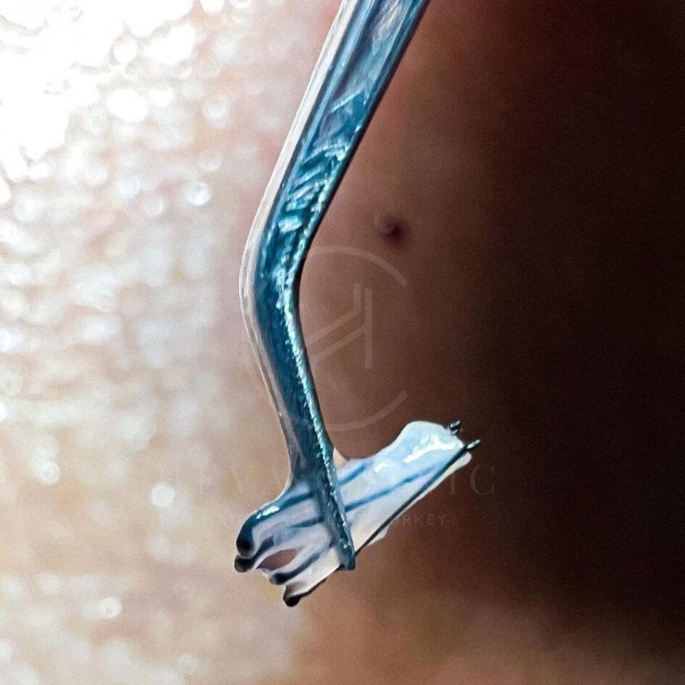 What Is a Hair Graft? - 1 Graft Equals How Many Hairs? What Is a Hair Graft? - 1 Graft Equals How Many Hairs?