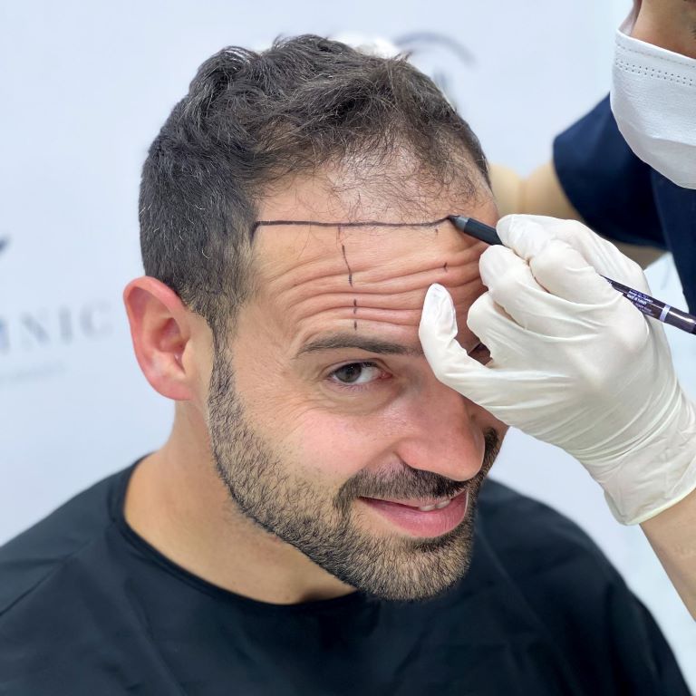 one session hair transplant hairline drawing