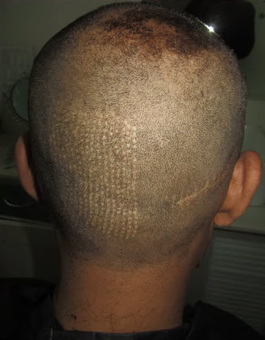 hair transplant overharvesting scar