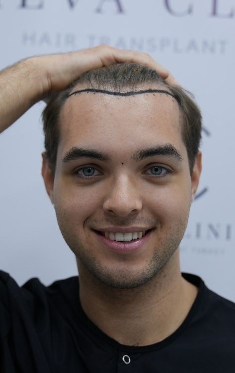 hair transplant