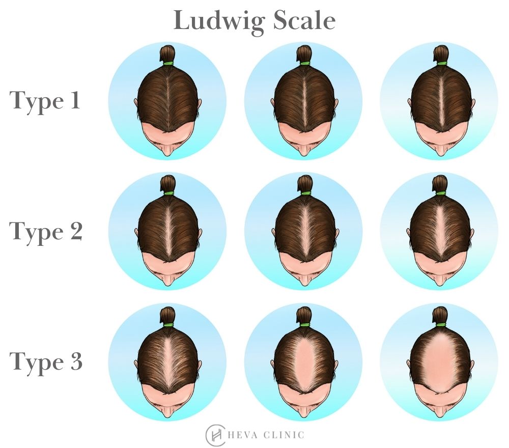 ludwig scale female hair loss baldness pattern chart