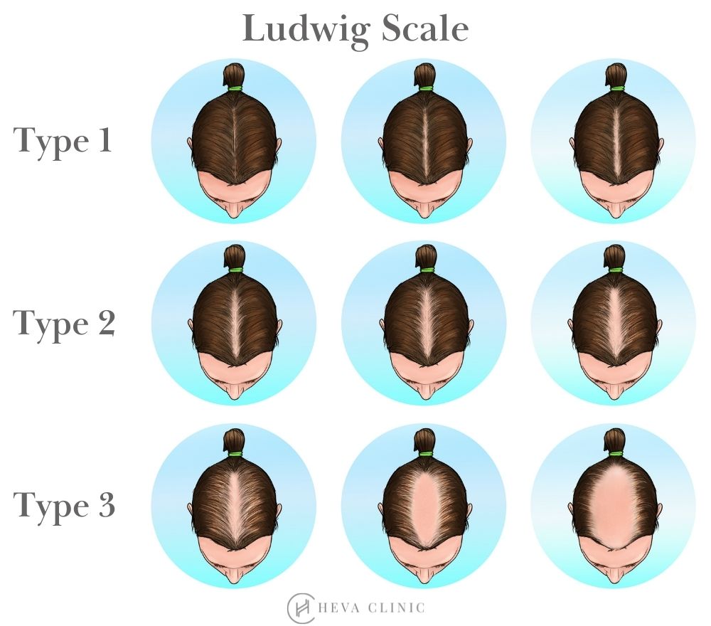 Frontiers  Female Pattern Hair Loss in Female and Male A Quantitative  Trichoscopic Analysis in Chinese Han Patients