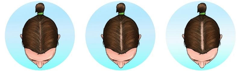 ludwig scale stage 1 female baldness pattern