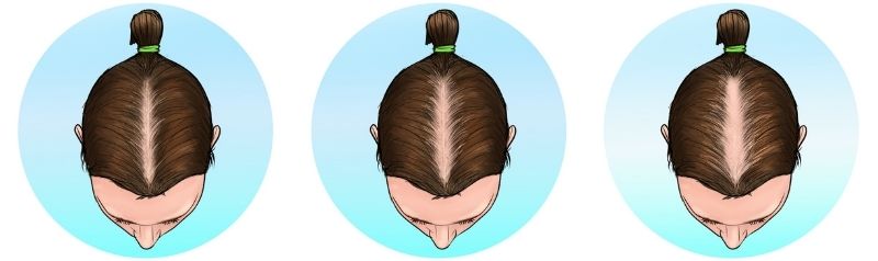 ludwig scale stage 2 female baldness pattern