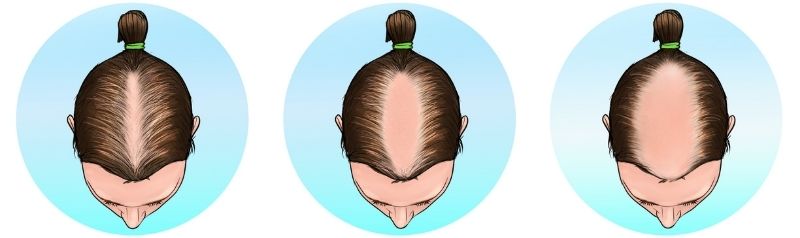 ludwig scale stage 3 female baldness pattern
