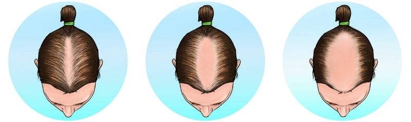 How can I treat female pattern baldness  according to three experts