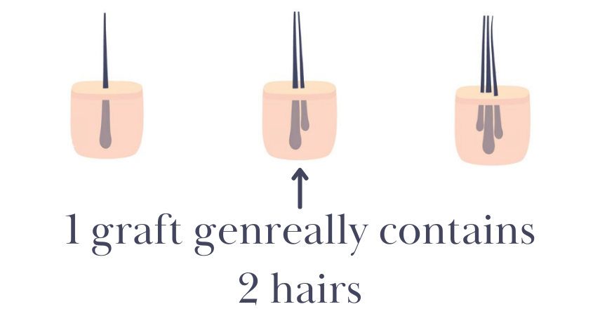 How many hair is 1 graft 1 graft generally contains 2 hairs