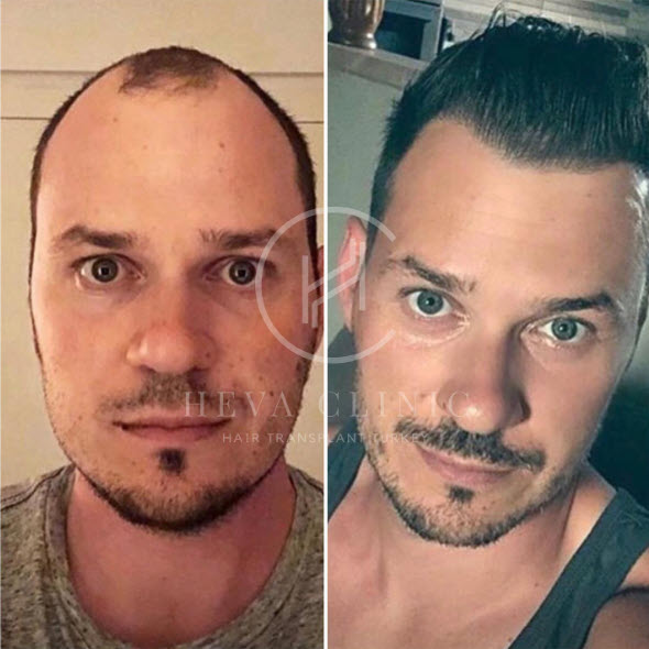 My hairline threatened my identity so much the ground felt shaky why hair  transplants are booming  Mens hair  The Guardian