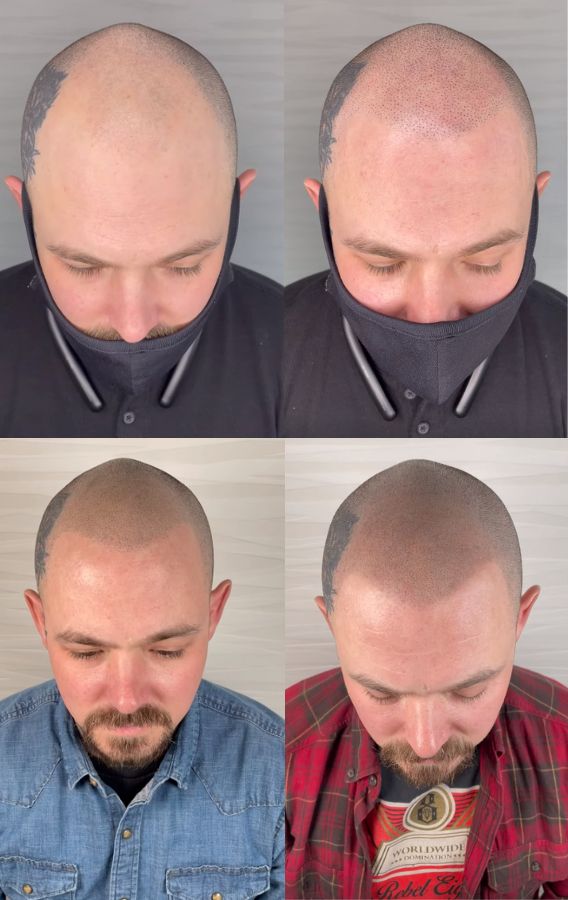 Scalp micropigmentation in Turkey before after photos