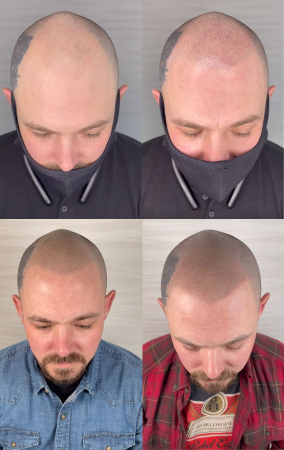 Scalp Micropigmentation