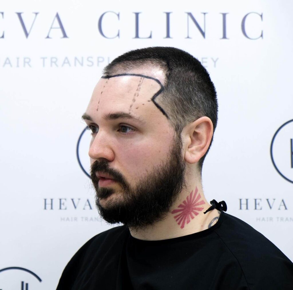rogaine before hair transplant candidate at heva clinic istanbul