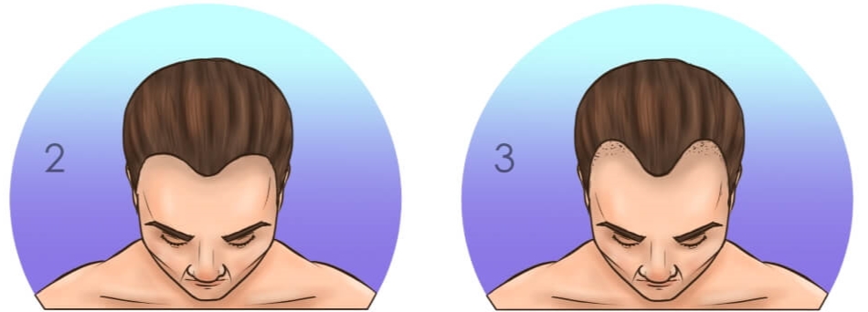 2000 grafts hair transplant cost store