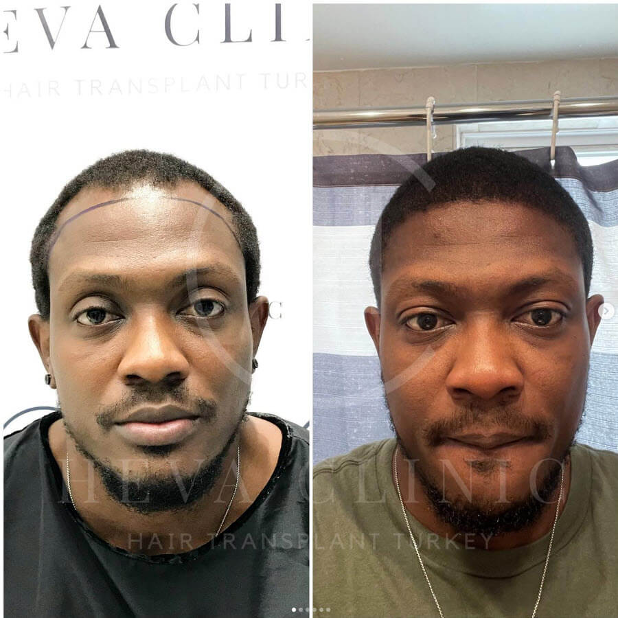 afro hair transplant 3000 grafts before and after istanbul at heva clinic